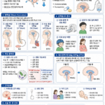 02. 수두증 간호