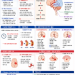 뇌졸중