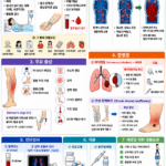 91. 심부정맥혈전증